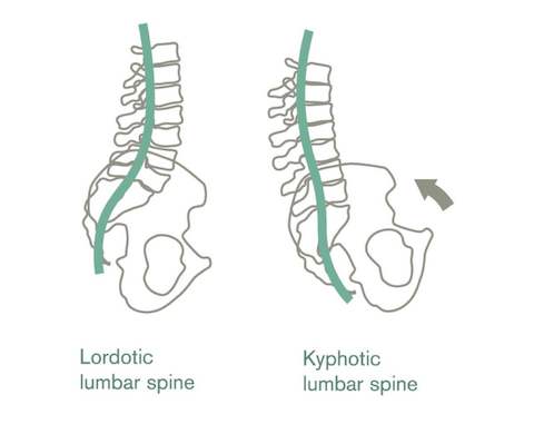 An illustration showing how the pelvis affects the lumbar spine's shape.